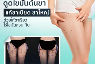 ดูดไขมันต้นขา แก้ขาเบียด