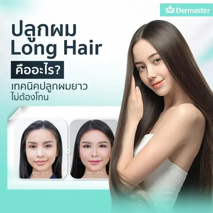 ปลูกผม Long Hair คืออะไร? เทคนิคปลูกผมยาว ไม่ต้องโกน