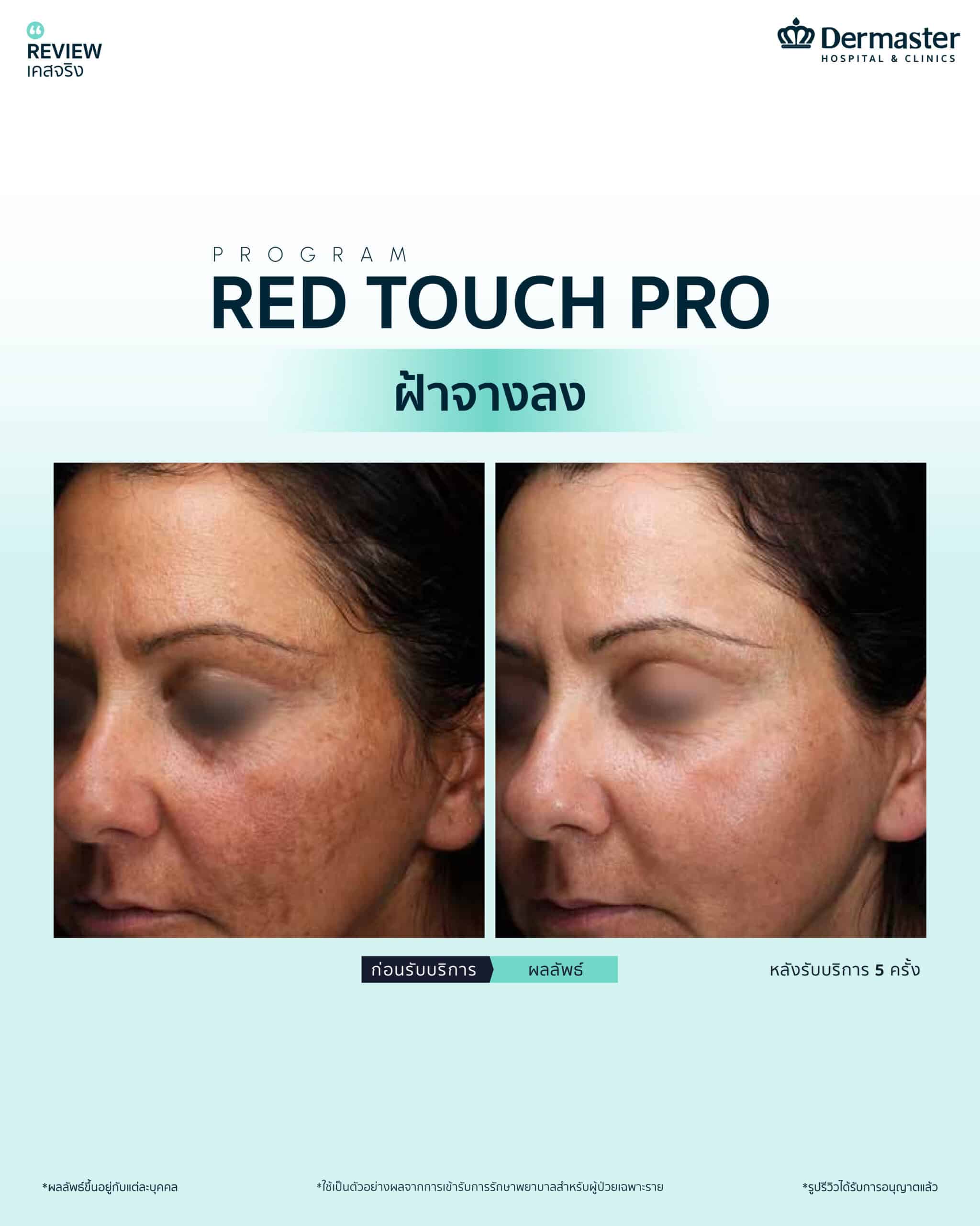 Red Touch Pro ฟื้นฟูผิวใส ลดริ้วรอยไม่ต้องพักฟื้น ไม่ตกสะเก็ด