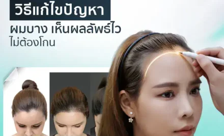 ปลูกผมผู้หญิง วิธีแก้ไขปัญหาผมบาง เห็นผลลัพธ์ไว ไม่ต้องโกน