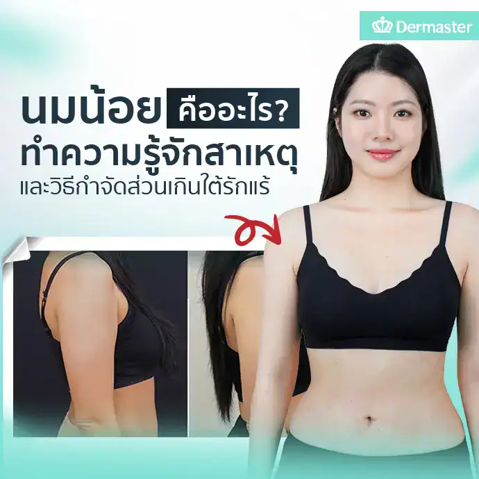 นมน้อยคืออะไร? ทำความรู้จักสาเหตุและวิธีกำจัดส่วนเกินใต้รักแร้
