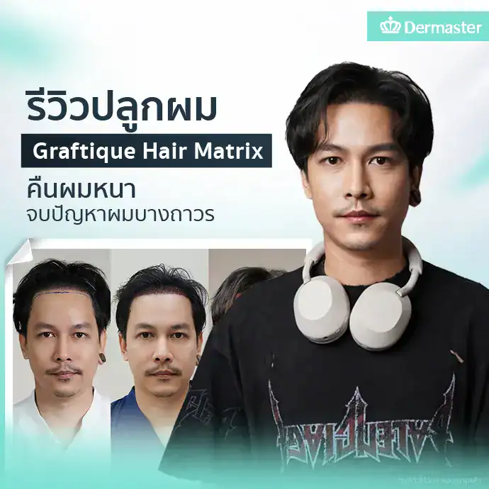 รีวิวปลูกผม Graftique Hair Matrix คืนผมหนา จบปัญหาผมบางถาวร