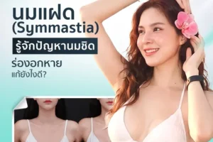 นมแฝด (Symmastia) รู้จักปัญหานมชิด ร่องอกหาย แก้ยังไงดี?