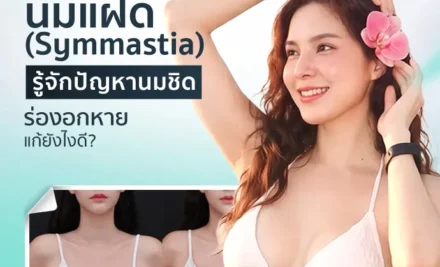 นมแฝด (Symmastia) รู้จักปัญหานมชิด ร่องอกหาย แก้ยังไงดี?