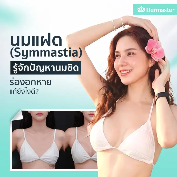 นมแฝด (Symmastia) รู้จักปัญหานมชิด ร่องอกหาย แก้ยังไงดี?