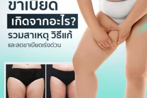 ขาเบียด เกิดจากอะไร? รวมสาเหตุ วิธีแก้และลดขาเบียดเร่งด่วน