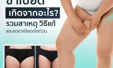ขาเบียด เกิดจากอะไร? รวมสาเหตุ วิธีแก้และลดขาเบียดเร่งด่วน