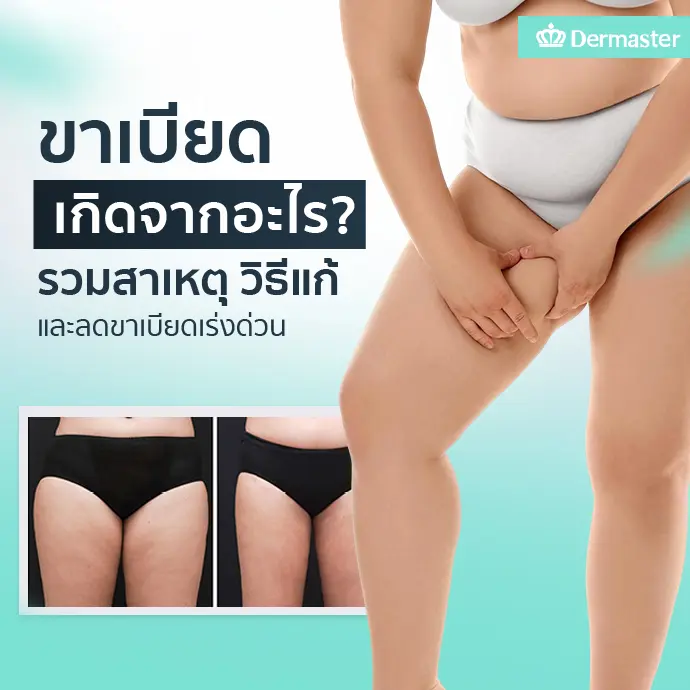 ขาเบียด เกิดจากอะไร? รวมสาเหตุ วิธีแก้และลดขาเบียดเร่งด่วน